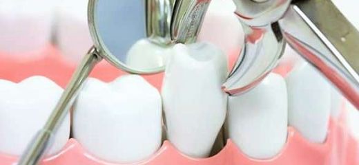Plombe ceramice la culoarea dintelui